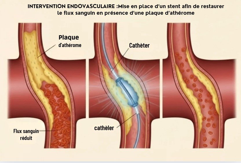 Chirurgie endovasculaire à Tanger - le Dr El Idrissi Redouane