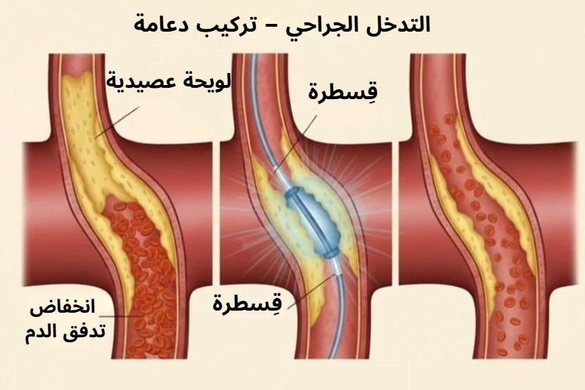 قسطرة الشرايين تركيب دعامة داخل الشريان
