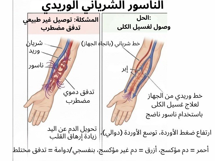 فستولة غسيل الكلى – الوصلة الشريانية الوريدية في الذراع