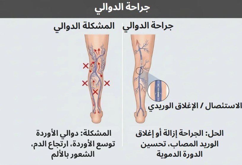 علاج دوالي الأوردة بالليزر في طنجة