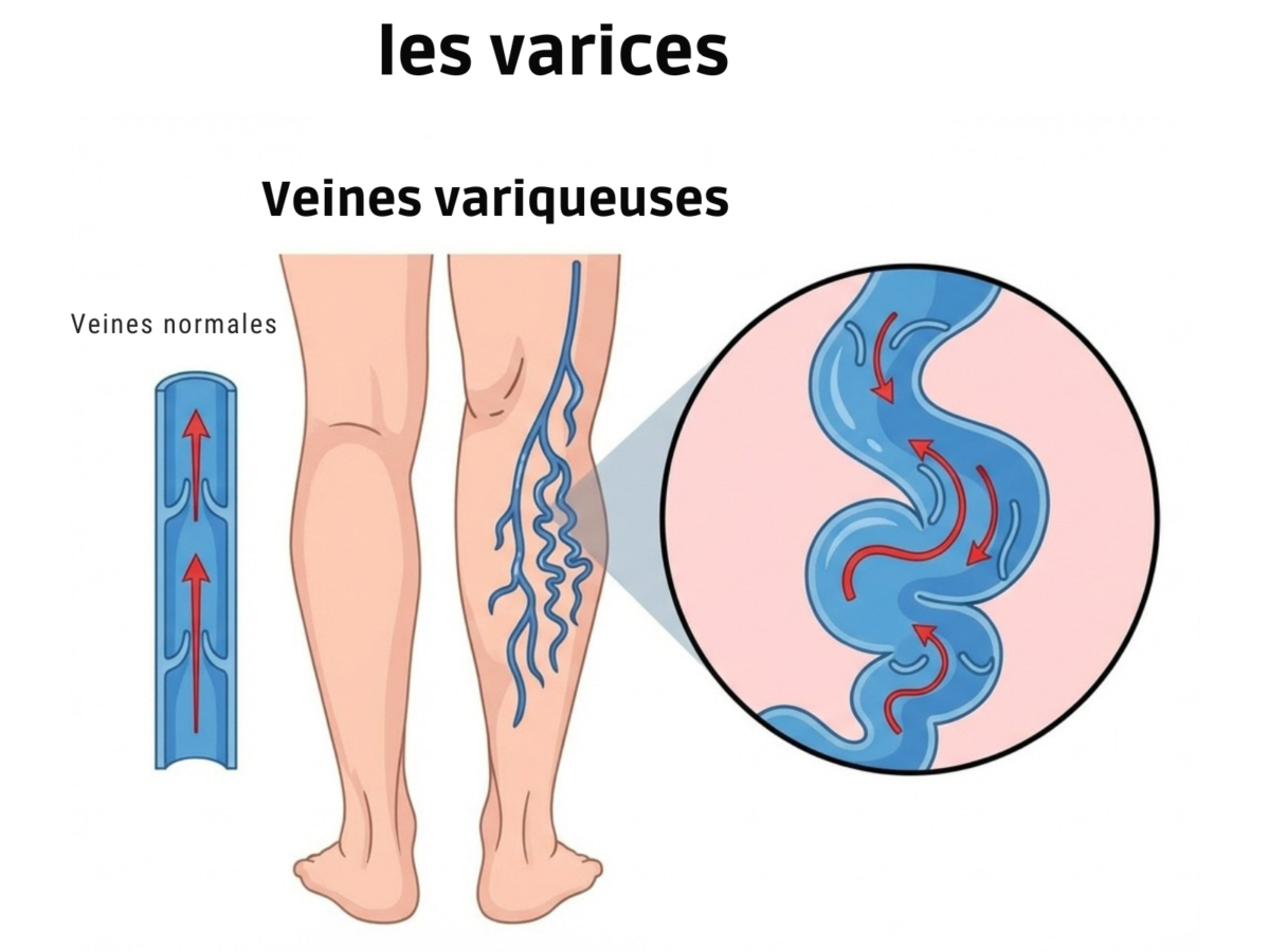 Veines-variqueuses-1-1-1200x900.png